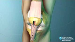 Anterior Cruciate Ligament ACL Reconstruction Animation [upl. by Sherie]