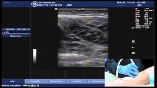 Hot Tips  Locating the Calf Vein with Ultrasound [upl. by Ylam]