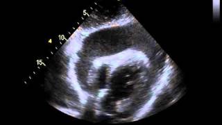 Echocardiography with a Significant Pericardial Effusion [upl. by Solitta736]