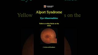 Alport Syndrome Eye Abnormalities [upl. by Corydon]