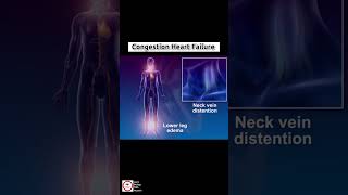 Congestive Heart Failure CHF  cardiology [upl. by Nosyla]