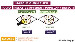 Abnormal Pupillary Reflexes  Ophthalmology [upl. by Caitlin]