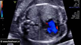 Fetal heart Academy  unbalanced AVSD 1 four chamber view color Doppler [upl. by Marpet13]