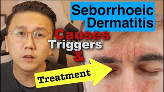 Seborrhoeic Dermatitis  Causes Triggers amp Treatment Options [upl. by Carolyne16]