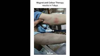 Herpes Zoster Results in 7 days by Magnet and Colour Therapy herpesvirus virotherapy arogyam [upl. by Gerrie]