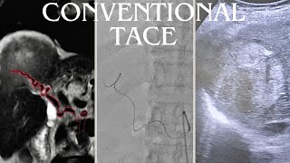 Managing Advanced Hepatocellular Carcinoma in an Elderly Patient A Case Study [upl. by Nesyrb]