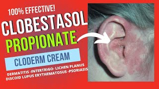 CLOBESTASOL PROPIONATE CREAM REVIEW [upl. by Aynik]