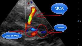 Pointofcare Transcranial Doppler [upl. by Constant646]