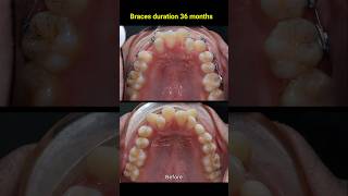 Braces evolution 36 months braces orthodontist dentist [upl. by Rojam647]