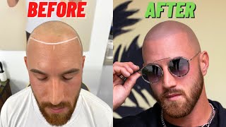 AMAZING Scalp Micropigmentation Transformation in Los Angeles California [upl. by Lebanna]