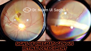 Clinical Signs Of Rhegmatogenous Retinal Detachment [upl. by Eislehc175]