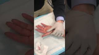 Cord rupture after Xiaflex injection for Dupuytrens Contracture [upl. by Ludlow]