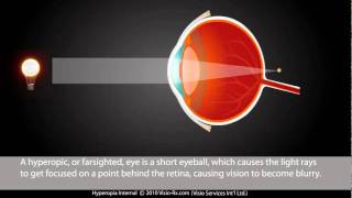 HyperopiaFarsightedness internal Prescription Glasses and Lenses [upl. by Kizzee770]