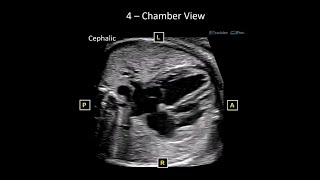 Basic Fetal Echo Protocol and Optimization [upl. by Zachariah36]