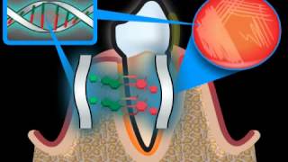 The term Periodontosis is not a correct medical term [upl. by Nnasor447]