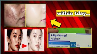 adaferin gel 01 reviews adaferin gel for acne scars [upl. by Terry171]