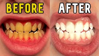 I tried the crest 3D whitestrips for 14 days effective 2023 [upl. by Eiralc]