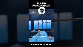 Plasmage para cicatrices de acné acnescars cicatrizdeacne cicatrizacion pielperfecta [upl. by Sakiv79]