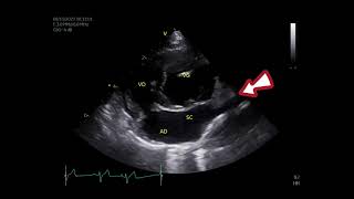 Pulmonic stenosis [upl. by Barri988]