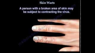 Skin Warts  Hand warts  Everything You Need To Know  Dr Nabil Ebraheim [upl. by Massie]