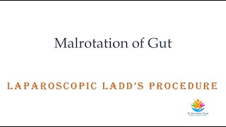 Malrotation  Ladds Procedure [upl. by Porta]