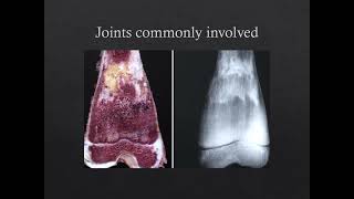 Gauchers Disease involving the MSK System [upl. by Mihcaoj365]