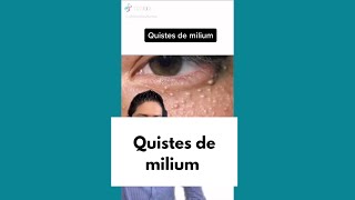 ¿Qué son los quistes de milium [upl. by Hunfredo929]