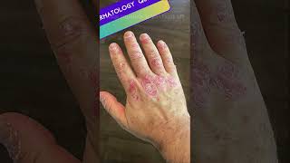 Dermatoses Resulting from Physical Factors Quiz  Part 2 medicalmcqs dermatologyquiz [upl. by Greer]