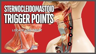 Understanding Trigger Points in the Sternocleidomastoid Muscle [upl. by Franklyn411]