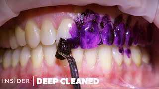 How Teeth Are Professionally Deep Cleaned  Deep Cleaned [upl. by Ahgiela]