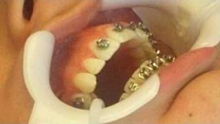 Orthodontist Places Braces on PatientSee how easy it is to get braces [upl. by Hunley]