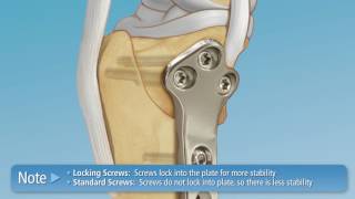 TPLO Chapter 6 The DePuy Synthes TPLO Plate [upl. by Anon667]