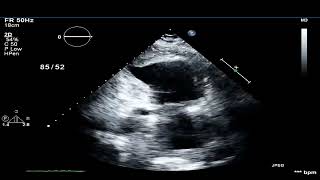 TTE Large Apical Thrombus  Post Infarct [upl. by Else]