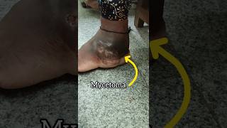 mycetoma🥺antee telusamadura footfoot carepreventiontreatementhealth caremanagementmedico vlog [upl. by Baler825]