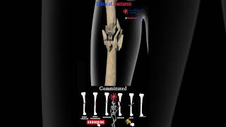 Types of bone fractures 🦴 bone fractures [upl. by Salamanca]