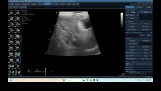 IQ 275 HEPATOMA ICTERUS ULTRASOUND PULMONARY EDEMAEFFUSION [upl. by Yattirb]