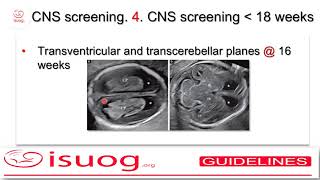 ISUOG guidelines on the sonographic examination of the fetal CNS part 1 [upl. by Deane]