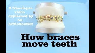 How braces move teeth timelapse  Braces Explained [upl. by Uahc]