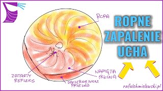 Ostre Ropne Zapalenie Ucha Środkowego — Widok Endoskopowy [upl. by Yrian26]