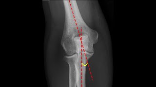 Normal elbow  Carrying angle and its importance [upl. by Rosalie]