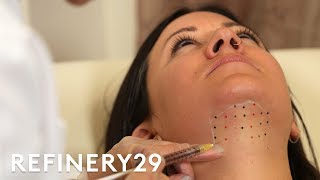 Kybella Double Chin Removal Treatment Up Close  Macro Beauty  Refinery29 [upl. by Lehte353]