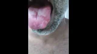 Geographic tongue [upl. by Eelsnia]