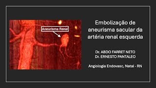 Embolização de aneurisma renal sem implante de Stent [upl. by Amarillis]