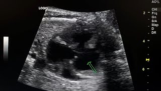 fetal ultrasound shows tricuspid atresia [upl. by Plante]