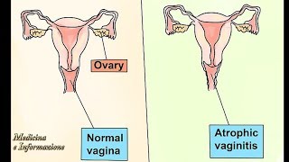 Sindrome Genito Urinaria in Menopausa atrofia vaginale dolore ai rapporti incontinenza cistiti [upl. by Akiraa481]