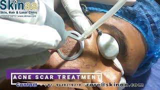 Acne Scar Laser Removal Treatment in Jaipur with Fractional Co2 FDA Approved Laser Skinaa Clinic [upl. by Ecenahs]