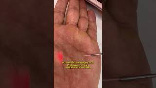 ENDOLASER  Elyon Dual Cromatic  Laser Subdérmico  Tudo Belo Estética [upl. by Adikram]