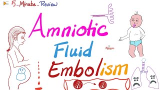 Amniotic Fluid Embolism  ObGyn Pathology Lectures  5MinuteReview Series [upl. by Eileme]