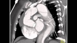 Vascular Type A Dissection of the Aorta following Valve Replacement and Composite Graft4 of 4 [upl. by Jay]