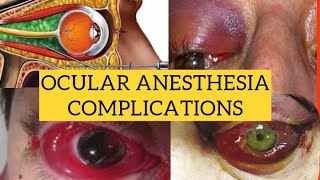 Complications of ocular anesthesia  Diagnosis and management [upl. by Zetrom]